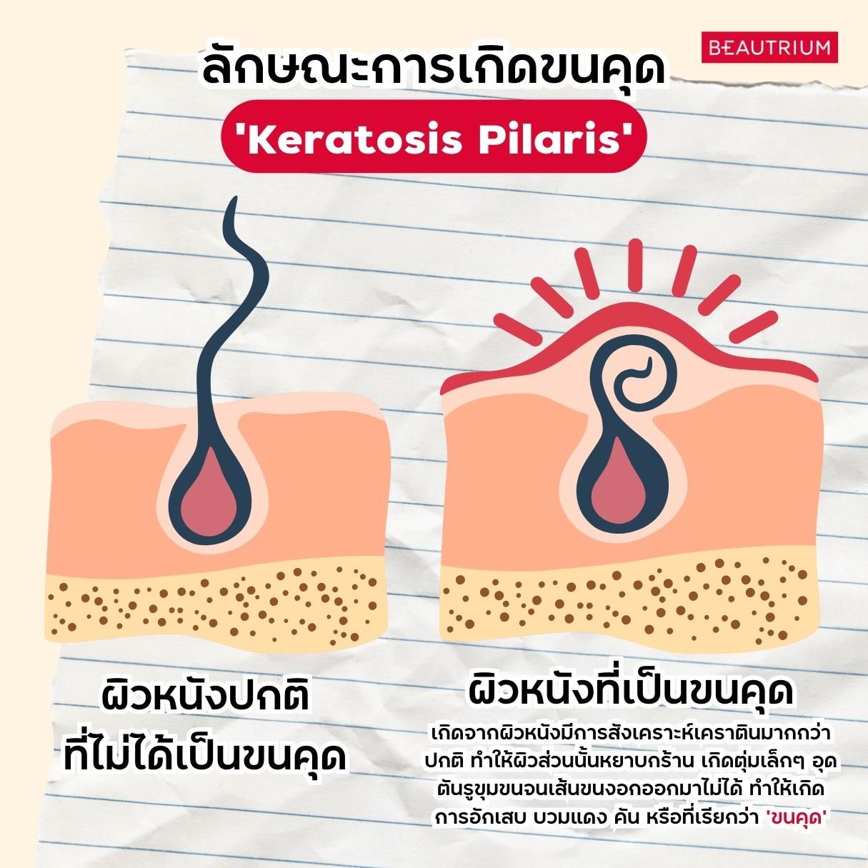 Keratosis Pilaris