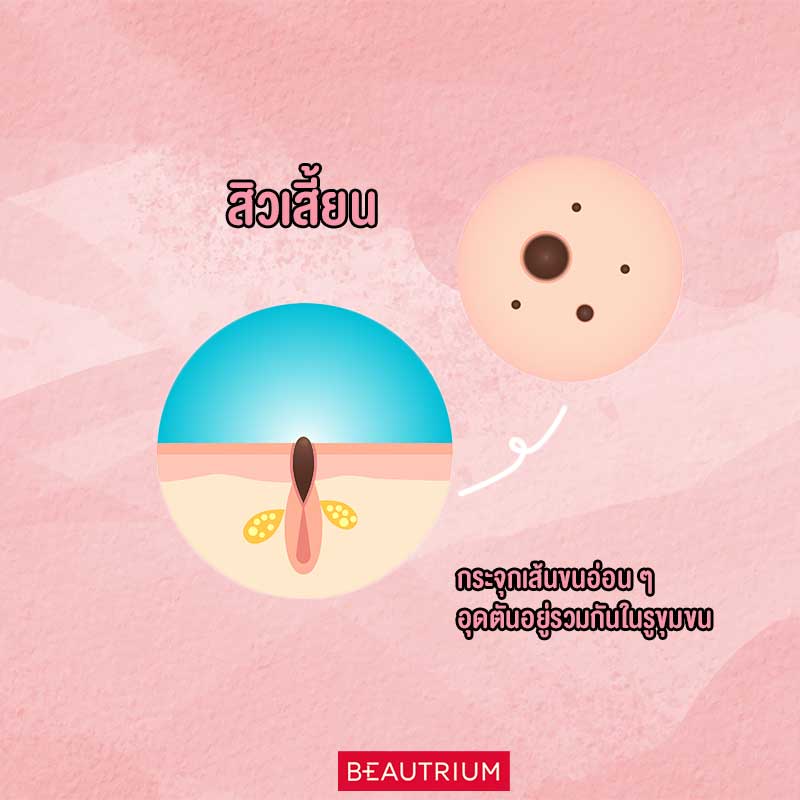 Blackhead