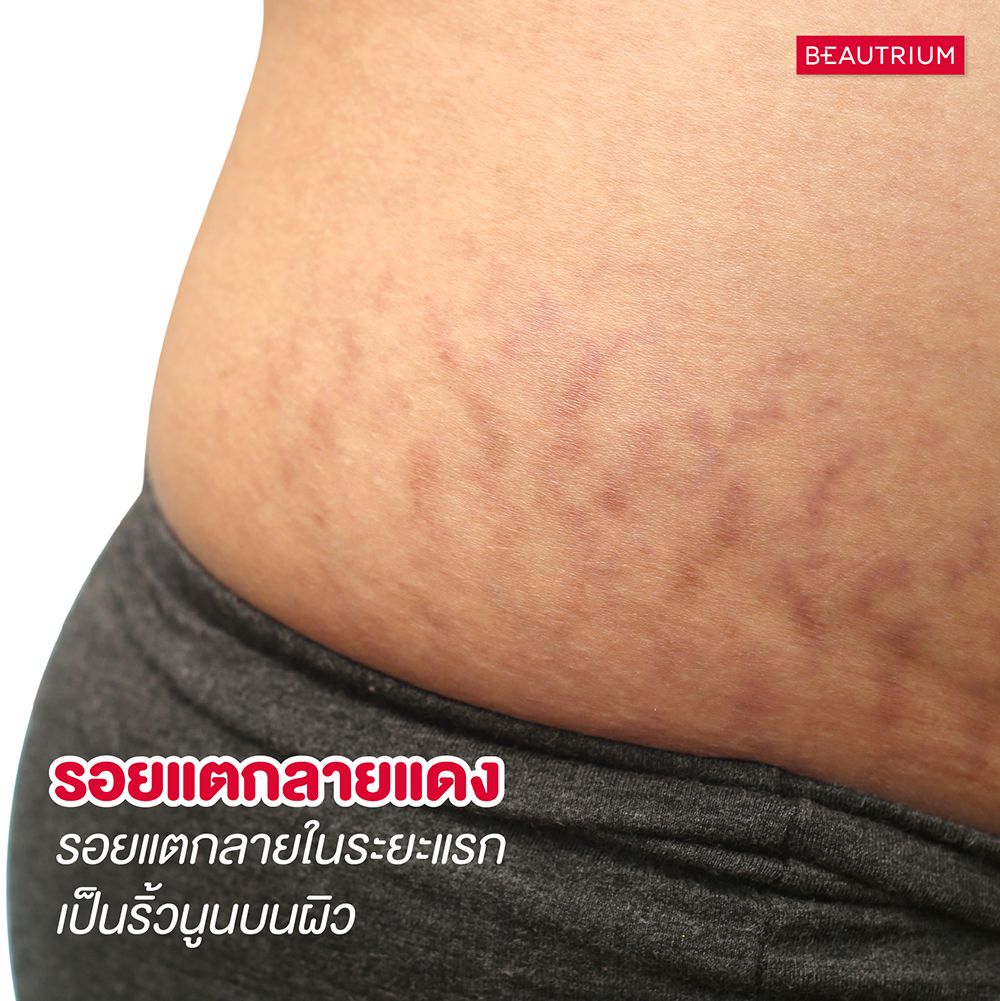 Stretch marks