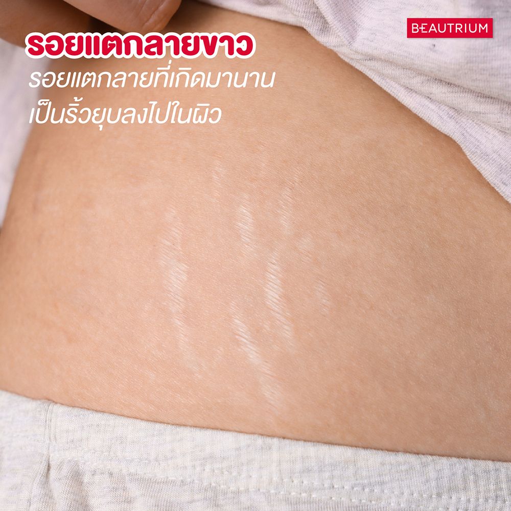 Stretch marks