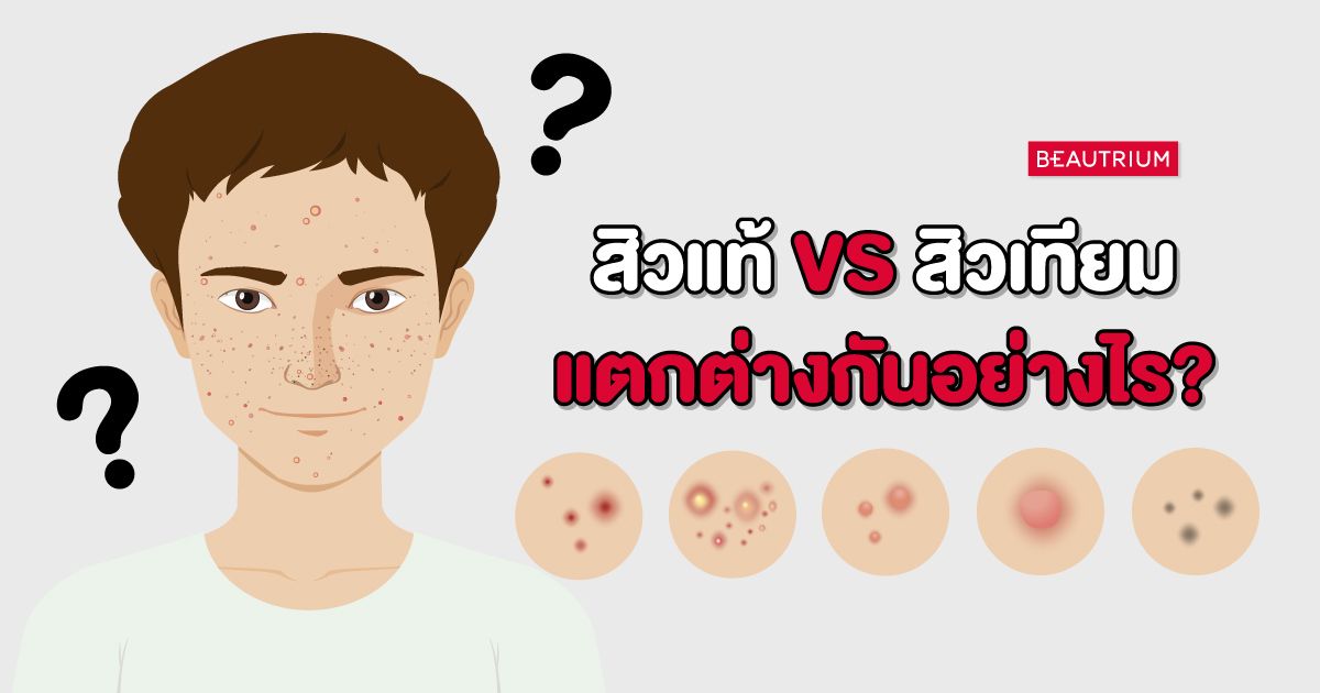 ไขข้อสงสัย | สิวแท้ VS สิวเทียม แตกต่างกันอย่างไร!?
