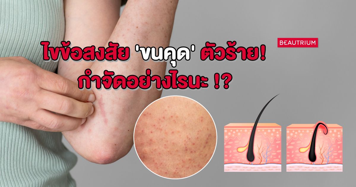 ไขข้อสงสัย | 'ขนคุด' ตัวร้าย กำจัดอย่างไรนะ!?