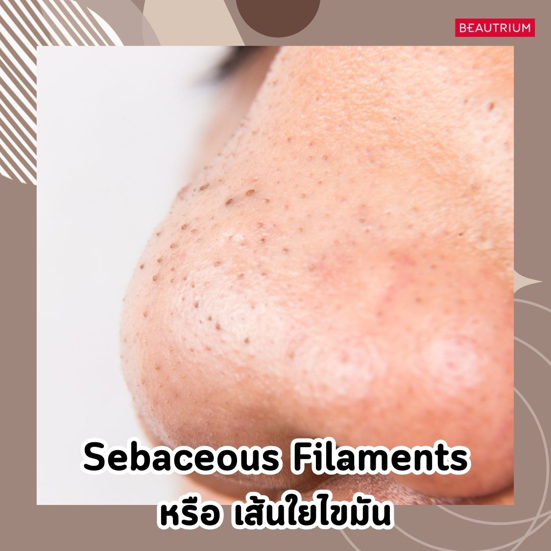  Sebaceous Filaments (เส้นใยไขมัน)