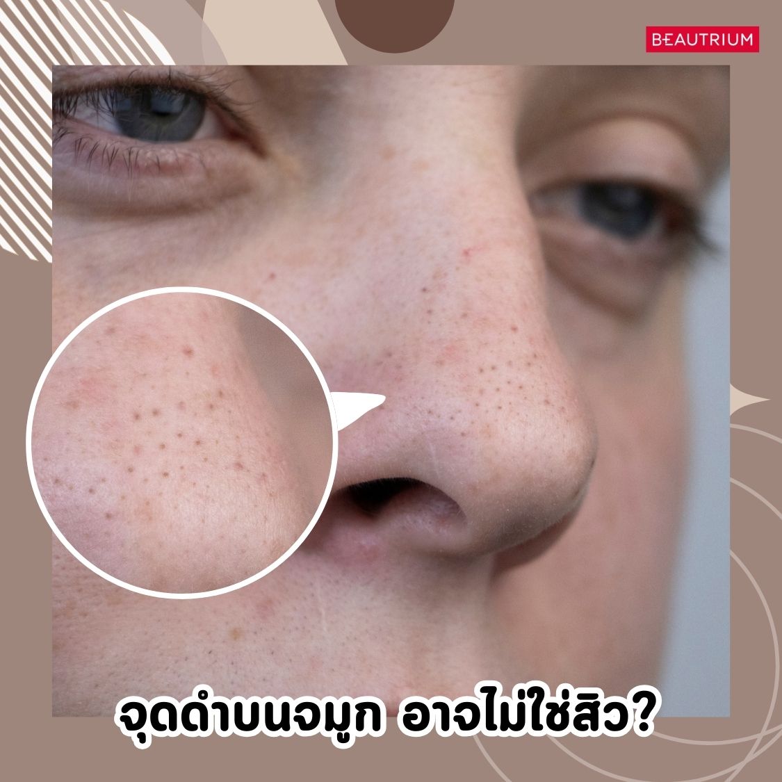 The dark spots on your nose might not be blackhead