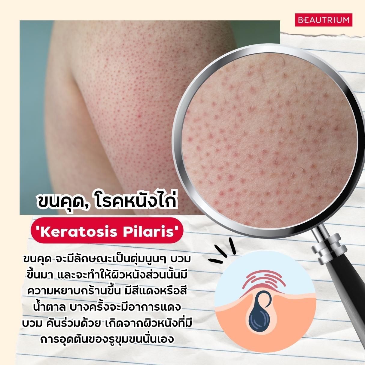 Keratosis Pilaris