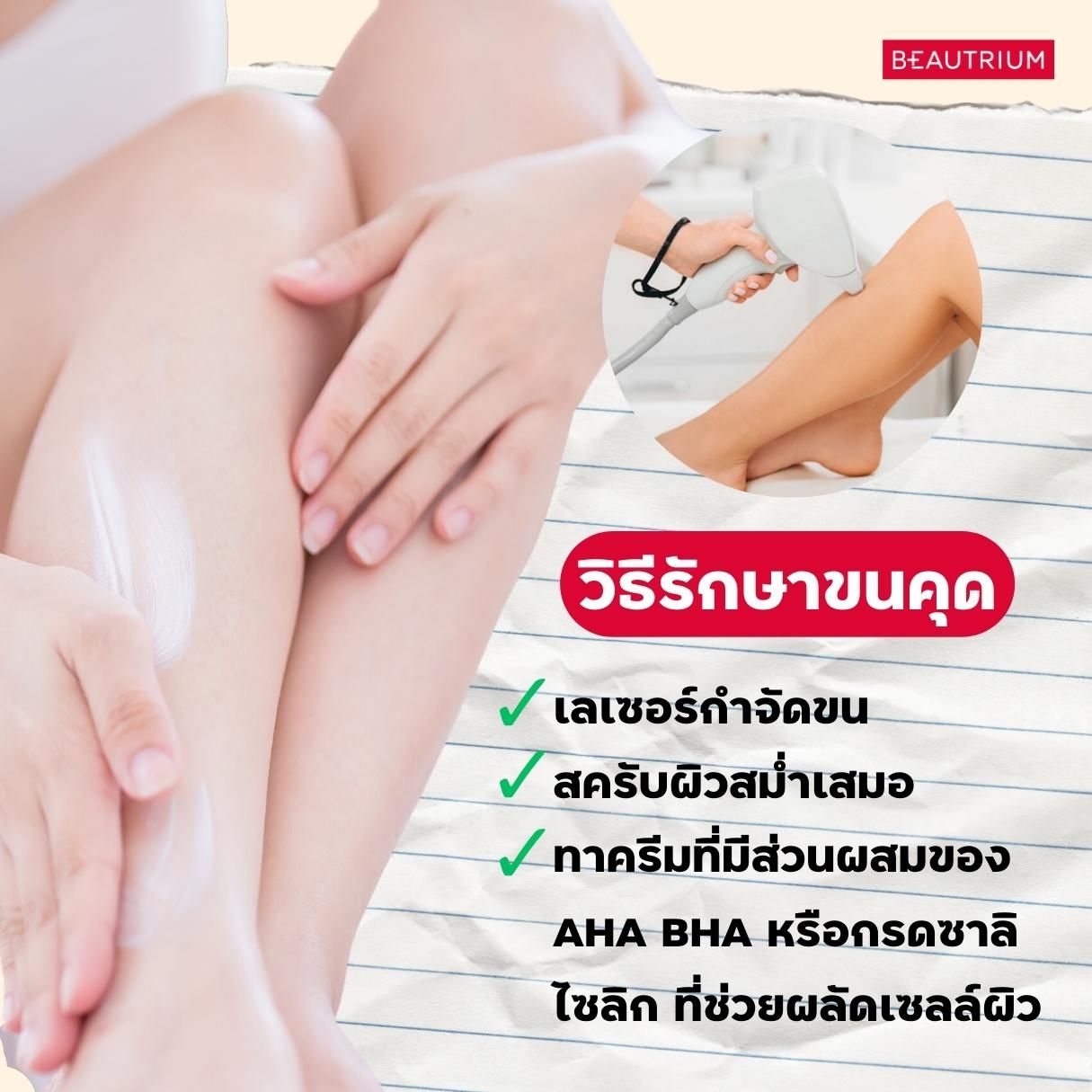 Keratosis Pilaris